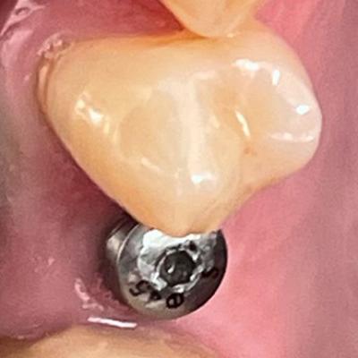 Implant Treatment