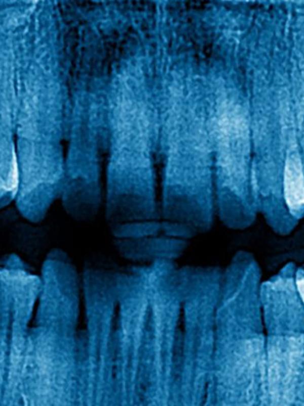 Impacted Wisdom Tooth Surgery