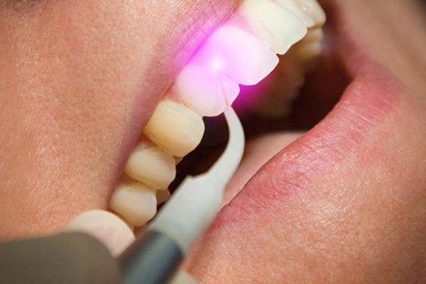 Laser Gum Surgery
