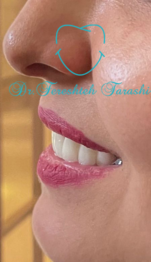 ایمپلنت و افسردگی