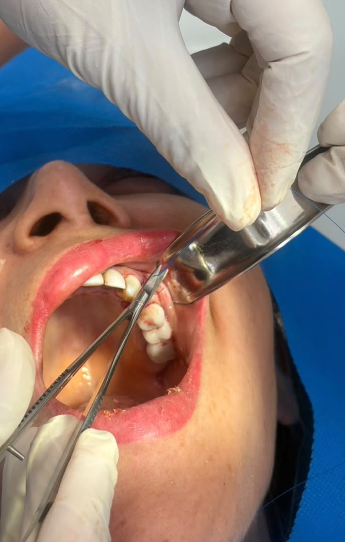 ایمپلنت دکتر فرشته تراشی