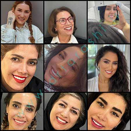 مقایسه کامپوزیت زیبایی و لمینیت سرامیکی در اصلاح طرح لبخند - دکتر فرشته تراشی
