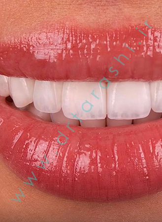 مقایسه کامپوزیت زیبایی و لمینیت سرامیکی در اصلاح طرح لبخند - دکتر فرشته تراشی
