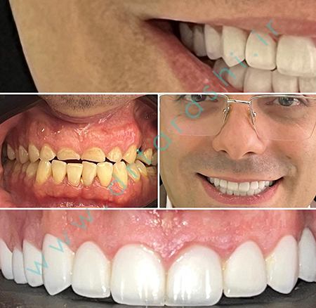 مقایسه کامپوزیت زیبایی و لمینیت سرامیکی در اصلاح طرح لبخند - دکتر فرشته تراشی