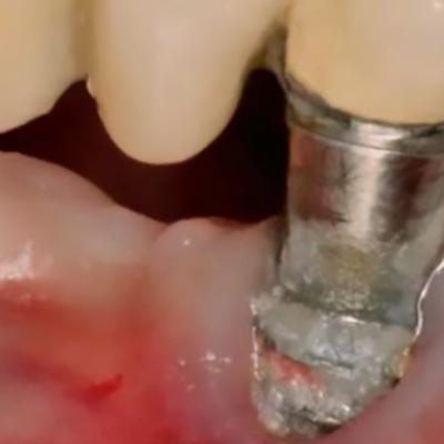 خطرات ایمپلنت‌های ارزان: چرا انتخاب هوشمندانه اهمیت دارد؟